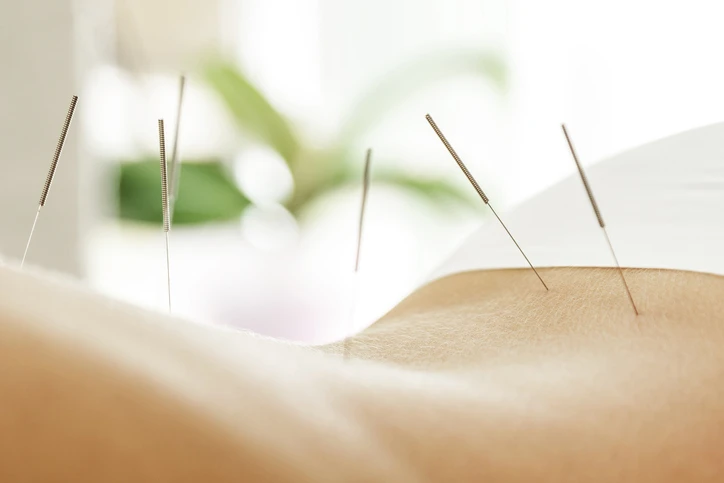 Beneficios de la acupuntura para la Fascia muscular.