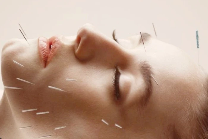 Facelift with Acupuncture